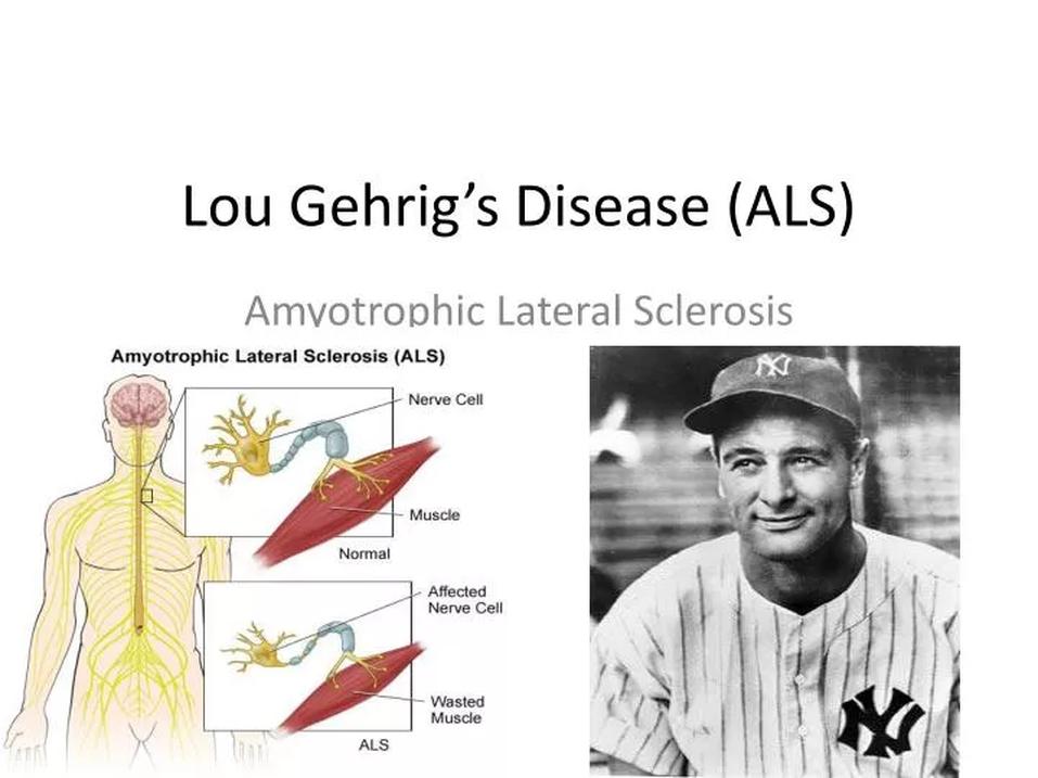 La SLA, aussi appelée maladie de Lou Gehrig, affecte les neurones moteurs, causant une perte progressive du contrôle musculaire. Cette maladie est fatale et incurable à ce jour. La durée de vie moyenne après diagnostic se situe entre deux et cinq ans, ce qui correspond à l'expérience du joueur.