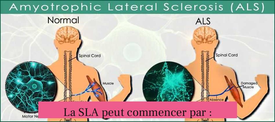 La SLA peut commencer par :